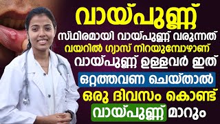 ഇത് ഒറ്റത്തവണ ചെയ്താൽ തന്നെ വായ്പുണ്ണ് ഒറ്റ ദിവസത്തിൽ മാറും  vaya punnu maran  Dr Juhi Das [upl. by Naillimxam874]