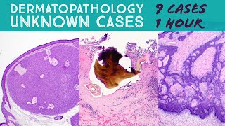 Random Dermpath Cases tick mouthparts Masson Pinkus Fournier gangrene etcdermatology pathology [upl. by Aeikan]