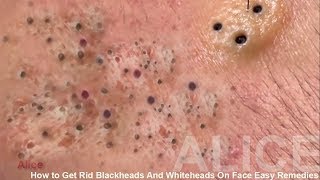 How to Get Rid Blackheads And Whiteheads On Face Easy Remedies [upl. by Ayanad194]