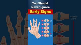 Could Arthritis Be Impacting Your Life Watch These Key Warning Signs [upl. by Koran593]