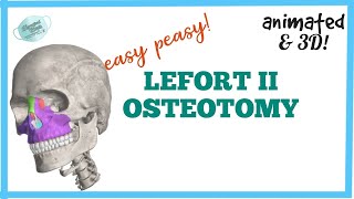 LEFORT II OSTEOTOMY  MAXILLARY OSTEOTOMY [upl. by Cletus]