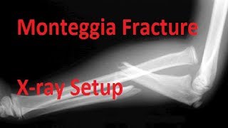 Monteggia Fracture Xray Setup [upl. by Cooke994]