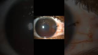 IntraocularForeignBodyCornealLacerationHyphemaIrisTearSomasundaramEyeHospitalKarur [upl. by Junie]