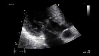 HYPERTROPHIC CARDIOMYOPATHY ECHOCARDIOGRAM  SAM [upl. by Ahsiuqel]