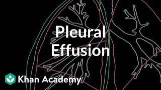 What is a pleural effusion  Respiratory system diseases  NCLEXRN  Khan Academy [upl. by Body]