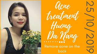 Acne treatment Hương Đà NẵngRemove acne on the back 25102019 [upl. by Culbert]