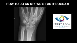 How to do an MRI wrist arthrogram [upl. by Meredith]