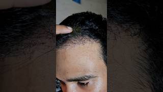 New Growth Baby Hair After Hair Transplant haircare newvideo result reels instagram hair [upl. by Akihsat]