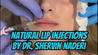 Natural Lip Injections with Juvederm Volbella [upl. by Katuscha]