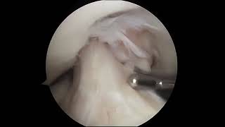 Torn Meniscus Arthroscopic Surgery [upl. by Hgieleak]