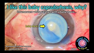 CataractCoach™ 2097 I like this baby capsulorhexis why [upl. by Noillimaxam]