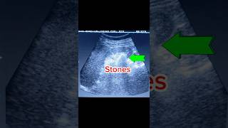 Renal calculi  Staghorn Stone Ultrasound [upl. by Noffihc]