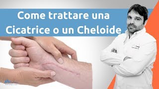 Come trattare una cicatrice cheloide [upl. by Broadbent]