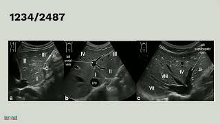 Liver sonoanatomy [upl. by Zwiebel89]