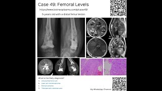 Case 49 Femoral Levels [upl. by Rosemary992]