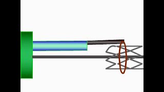 Angioplasty technique Retrieval of a stent migrated in the coronary English subtitle [upl. by Ymmac]