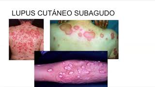 Lupus Eritematoso Sistémico Dra Consani [upl. by Cogen]