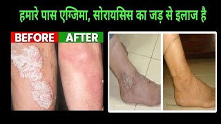 psoriasis treatment  Psoriasis cream [upl. by Aerahs]