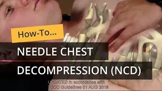 Needle Chest Decompression in TCCC [upl. by Marge446]