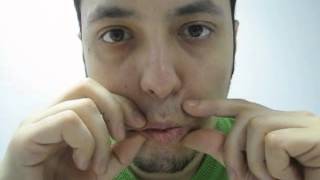 FACIAL PARESIS EXERCISE 6 AFTER ACOUSTIC NEUROMA SURGERY [upl. by Erdah]