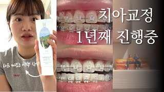 치아교정 시작한지 드디어 1년 검안사 일상 타나카타츠야 미니어처 전시 칸디데 미백치약 [upl. by Celeste]