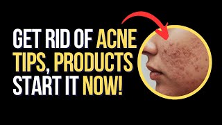 Get RID of ACNE Tips and Products Get RID NOW [upl. by Neoma445]