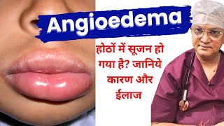 मेरे होंठ सूज गए Angioedema  Swelling of lips and face ANGIOEDEMA Causes Symptoms and Treatment [upl. by Abrahams]