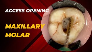 Access Opening of Maxillary Second Molar [upl. by Ased]