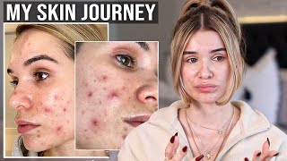 My Skin Story Going on ACCUTANE [upl. by Ahsratal498]