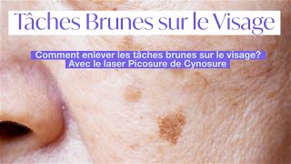 Tâches brunes sur le visage hyperpigmentation de la peau  retrait avec le laser picosure cynosure [upl. by Ainek]