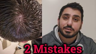 Hair Loss Mistakes  My Hair Journey  FAILED [upl. by Miharbi]