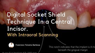 Digital Socket Shield Technique [upl. by Vada]