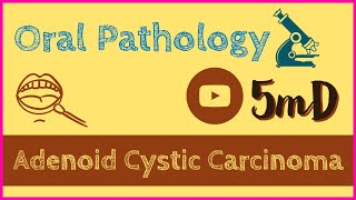 ADENOID CYSTIC CARCINOMA  Salivary gland tumour  Oral Pathology  easy notes [upl. by Marie-Ann936]