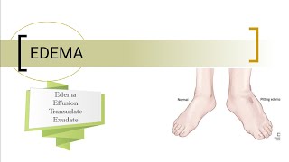 EDEMA PATHOLOGY 📚ROBBINS AND COTRAN  Competency based [upl. by Uolyram]