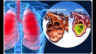 Acute Respiratory Distress Syndrome ARDS [upl. by Hose]