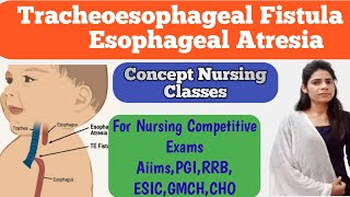 Tracheoesophageal Fistula and Esophageal Atresia pediatrics important topic [upl. by Ovatsug]