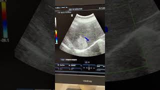 Hepatic Mets  Hemangioma ultrasound sonography hemangioma liver mets hepatic [upl. by Marlea]