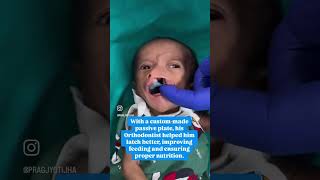 Free Cleft Surgery at gsrhospital hyderabad india cute baby cutebaby babyshorts babylove [upl. by Enitsyrk381]