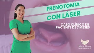 FRENECTOMÍA LINGUAL CON LÁSER EN BEBÉS [upl. by Enrobso]