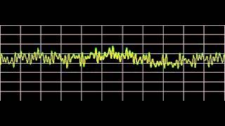 Osteoporosis  Rife Frequencies [upl. by Anelrats]