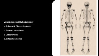 Fibrous Dysplasia MCQs SCFHS bonescan nuclearmedicineMCQ nuclearmedicine frcr bonescan [upl. by Rubma]