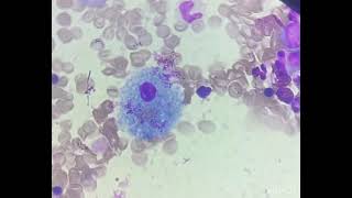 Sea Blue Histiocyte It’s a macrophage Has ceroid and lipofuscin granules in its cytoplasm [upl. by Yezdnil]