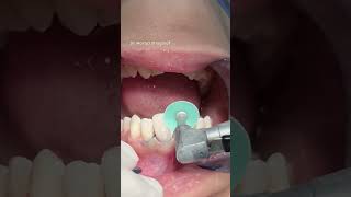 Dental composite veneer satisfying [upl. by Abott]