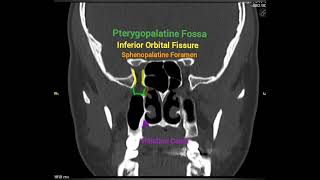 Coronal CT anatomy of Foramen Rotundum and Pterygopalatine Fossa [upl. by Anitsirt]