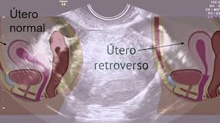 ¿Sabías que el útero en retroversión es un mito [upl. by Morty]