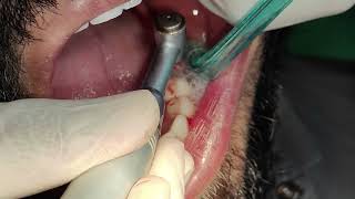 Lower left side first molar implant placement [upl. by Dynah]