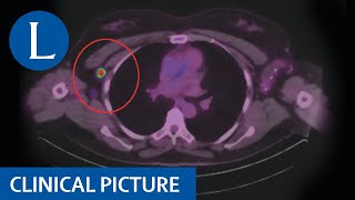 COVID19 mRNA vaccinerelated adenopathy mimicking metastatic melanoma [upl. by Nathanson620]