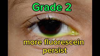 Fluorescein Dye Disappearance Test FDDT grading [upl. by Innad]