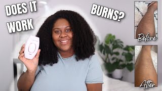 LASER HAIR REMOVAL ON DARK SKIN 4 Weeks Review  RoseSkinCo [upl. by Stonwin934]