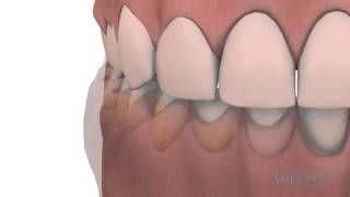 Gingivoplastie et gingivectomie  Centres dentaires Lapointe [upl. by Noyahs]